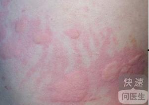 吃瓜过敏皮疹,揭秘过敏源与应对策略  第1张
